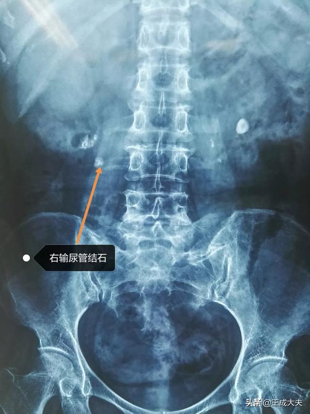 怀疑自己有肾结石怎么检查最准确?