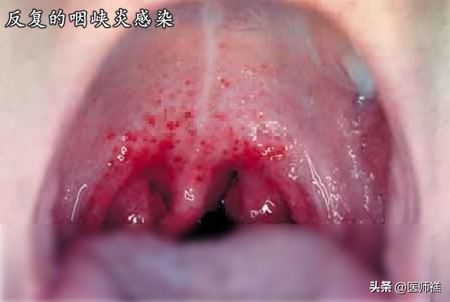 心肌缺血的早期症状,心脏病的早期症状是怎样的？