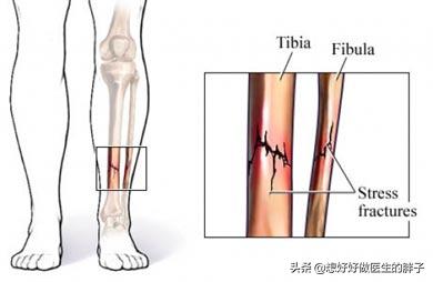 小腿轻微骨裂的症状:小腿骨裂纹保守治疗三个月，下地走路腿疼什么原因？