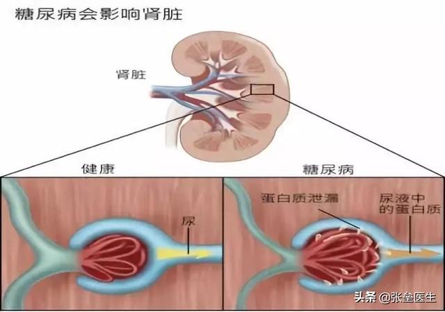 晚期糖尿病有什么症状:晚期糖尿病者都有什么症状 糖尿病肾病有什么早期症状？