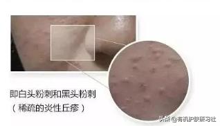 面部螨虫图片:脸上的毛孔居然是“螨虫养殖场”，这是为什么？怎么除掉螨虫？