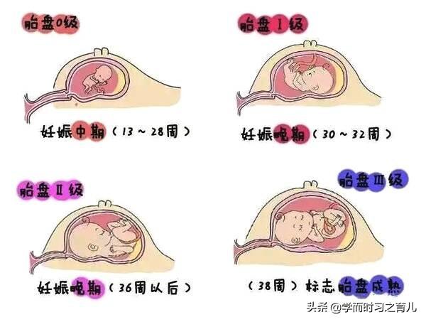 胎盘成熟度2级图片