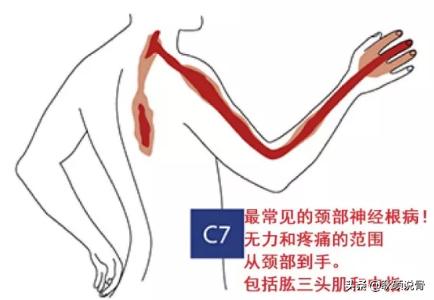 颈神经根炎的症状与治疗:颈椎椎间盘突出C3C4C5压迫神经根及硬膜囊是什么症状？