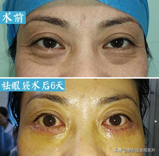 眼袋该怎么办(突然发现有眼袋了怎么办)