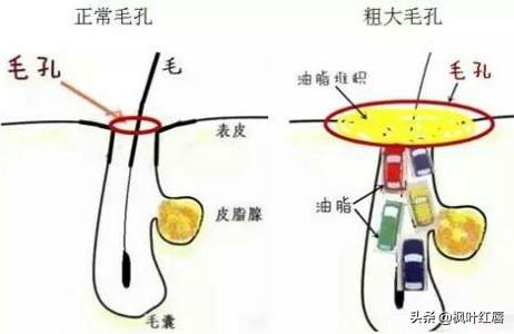 果酸换肤效果如何:果酸换肤祛痘印效果如何