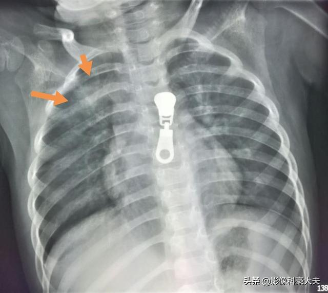 过敏淋巴细胞比率偏高:为何去医院看病，普通的感冒都需要验血拍片？