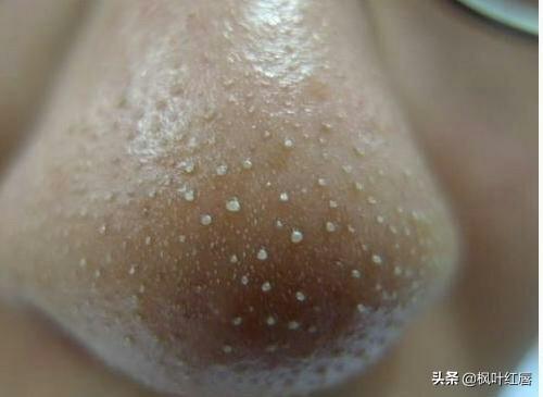 人身上被螨虫咬的图片是什么样的:被螨虫咬过的图片是什么样 大量螨虫塞满毛孔，皮肤会出现什么明显的迹象呢？