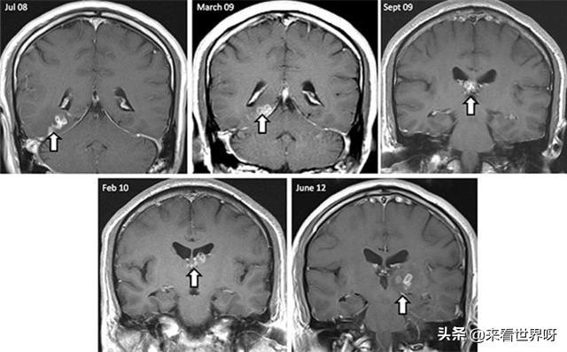 头条问答 - 如何看待美国消失了20多年的"食脑虫"再现呢?(11个回答)