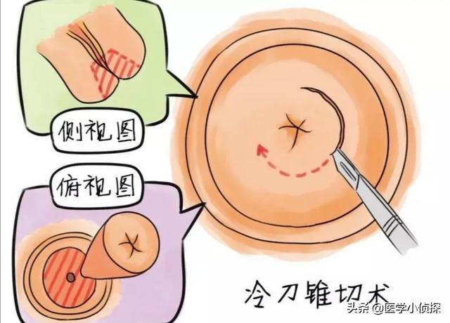疣状表皮发育不良:女子打过hpv疫苗，6年后却查出宫颈癌，疫苗不管用吗，为何？