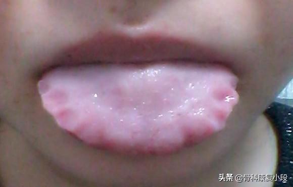 舌头胖大有齿痕，需要怎么调理？插图19