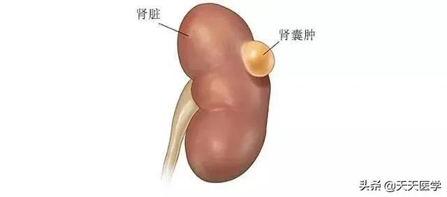 只有一个肾有囊肿要处理吗:左肾囊肿是什么问题，医院开了消炎药和止痛药，请问这能根治吗？