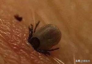 蜱虫叮咬后连发高烧都不知道了,是不是很严重啊？