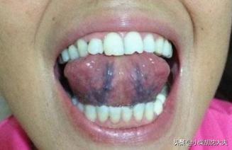 舌头下面有血丝图片图片