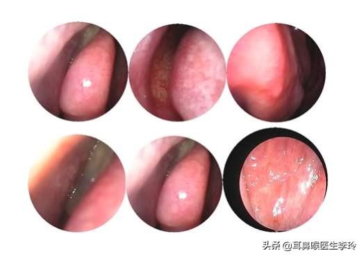 右鼻孔经常堵,里面有肉包,缝隙很小很小,通红通红的,没有其他症状到底