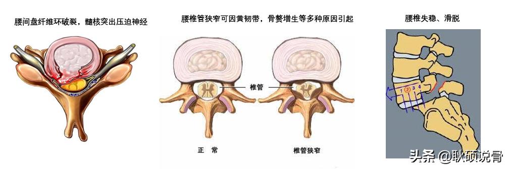 脊椎间盘突出怎么治疗:得了椎间盘突出怎么治疗好 腰椎间盘突出大家都怎么治疗的，有没有什么好办法分享？