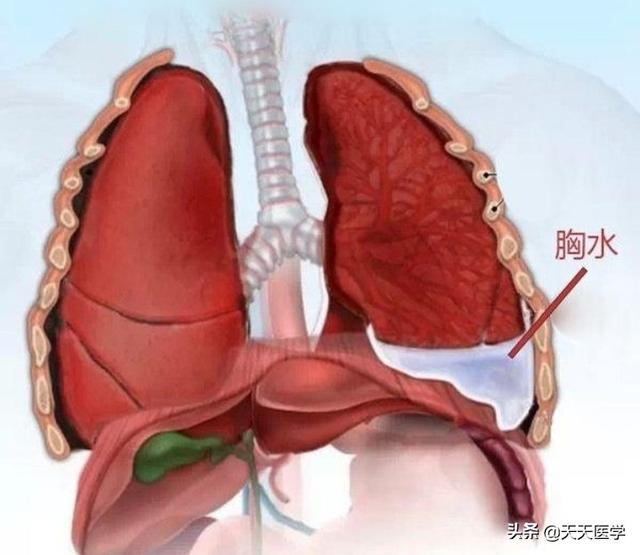 老年人胸腔积液病因有哪些，胸腔积液的分类有哪些胸腔积液和肺积液有什么关系吗