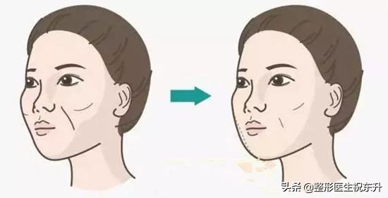 女生脸部护理小知识:女生脸上法令纹是什么？又该如何护肤抚平法令纹呢？