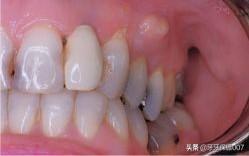 儿童补牙(儿童补牙一般多少钱一颗)