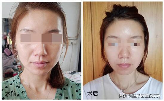 面部提升的最佳方法(面部提升的最佳方法2021年)