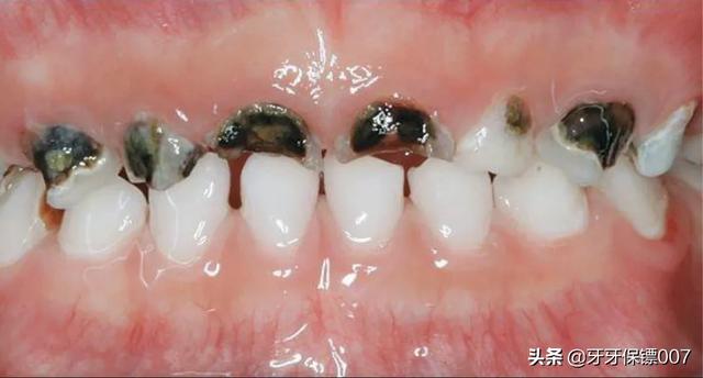 儿童补牙(儿童补牙一般多少钱一颗)