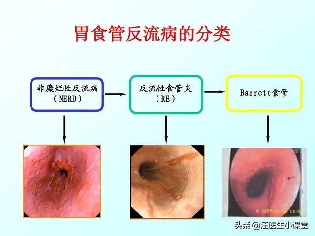 千草堂螺旋藻精片能保护肠胃吗:胃发酸，喉咙有异物感，口里发热，还口干口苦，是怎么回事？