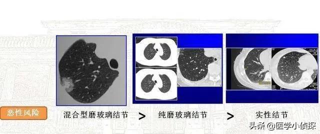 养生堂代茶饮方治疗肺部结节,肺结节喝什么水好能散结？