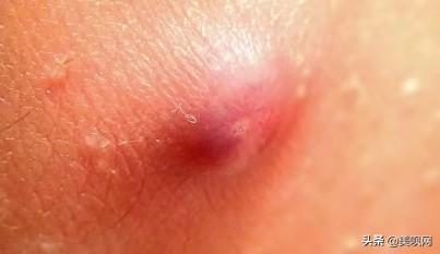 激光tuomao:激光脱毛能永久脱毛吗? 永久性脱毛的方法有哪些？
