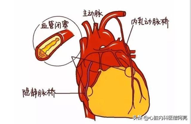 风靡<a href=https://maguai.com/list/256-0-0.html target=_blank class=infotextkey><a href=https://maguai.com/list/256-0-0.html target=_blank class=infotextkey>朋友圈</a></a>的血管栓塞消融新<a href=https://maguai.com/list/30-0-0.html target=_blank class=infotextkey><a href=https://maguai.com/list/30-0-0.html target=_blank class=infotextkey>科技</a></a>:心血管堵塞除了放支架之外，国外还有更加先进的治疗方法吗？