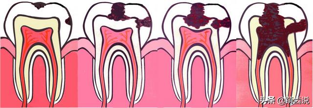儿童补牙(儿童补牙一般多少钱一颗)