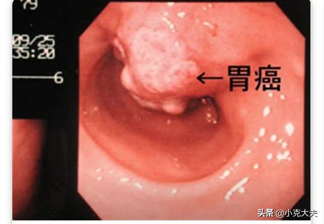 7莱姆病症状太容易被忽视:哪些不良习惯会引发肠癌？