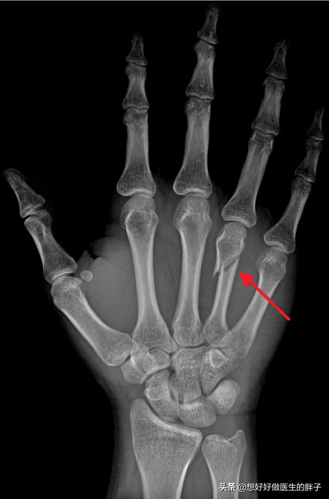 头条问答 - 手掌掌骨骨折半年没有长好,是什么原因?该怎么治疗?