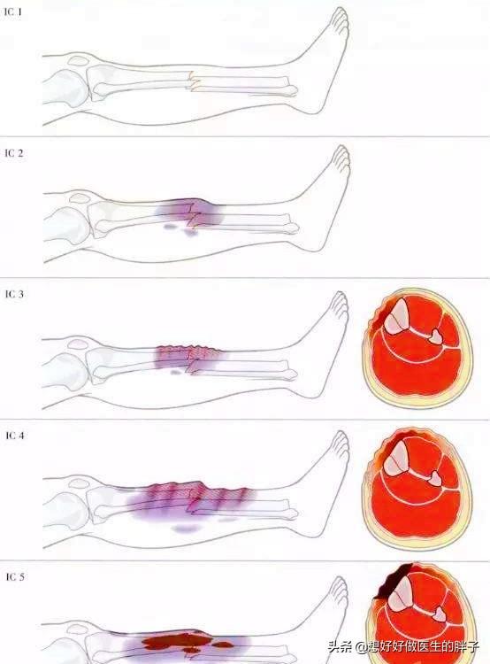 胫腓骨骨折手术后图片:小腿胫腓骨骨折内固手术后一个月为什么小腿下垂，脚变了色？