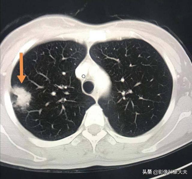 过敏淋巴细胞比率偏高:为何去医院看病，普通的感冒都需要验血拍片？