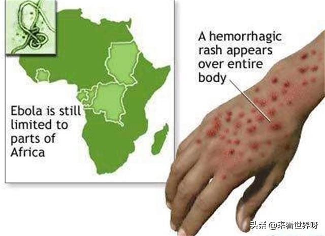 据昨日世卫组织消息,非洲刚果地区爆发第二次埃博拉疫情,已有6名感染