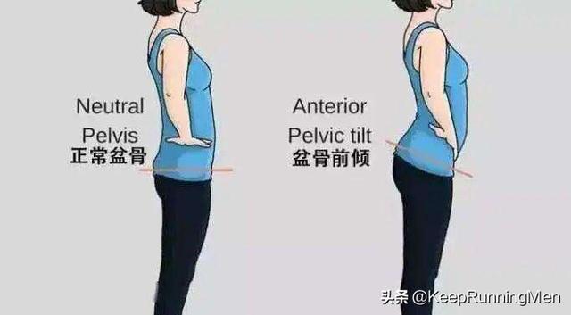 骨盆前倾有什么有效的矫正方法吗？