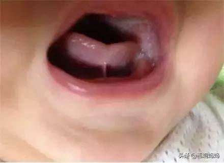 W型下巴是一种潮流吗，请问婴儿伸出舌呈轻微w型怎么办