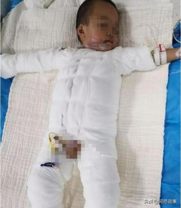 俞灏明抑郁症:因邻居逗弄，广西2岁男童跌入热油桶，全身重度烧伤，怎么回事？