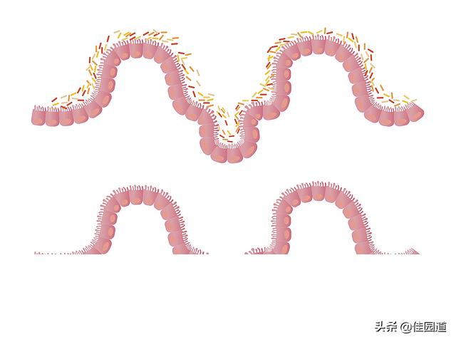 吃斯利安大便发黑是什么原因:大便呈棕黑色是肠癌的症状吗，该注意什么？