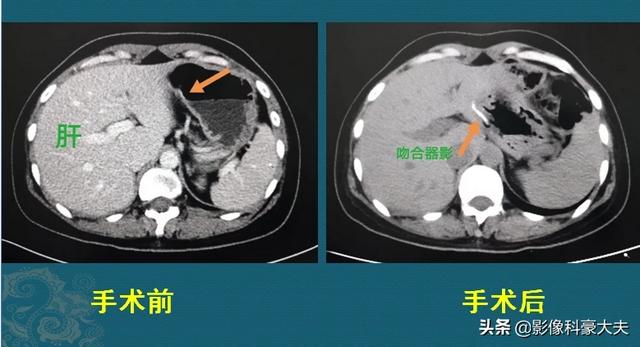 不影响寿命的十大癌症:哪些癌症是已发现且好治疗的？ 不影响寿命的十大癌症 肾癌