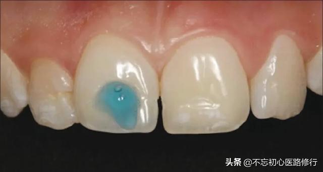 轻度四环素牙是什么颜色:四环素牙涂什么颜色的口红 什么是牙齿美白，什么样的牙齿适合美白？