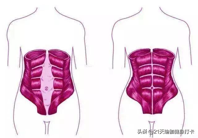 如何避免怀孕腹直肌分离:刨腹产后腹直肌会自我修复吗？