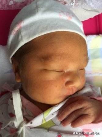 头条问答- 新生儿10个有9个黄疸，如何快速去黄疸？(35个回答)