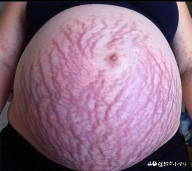 怀孕多久会长妊娠纹？为什么会长妊娠纹？插图12