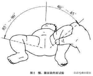 先天性髋关节脱位:什么是发育性髋关节脱位？髋关节脱位的孩子有什么表现？