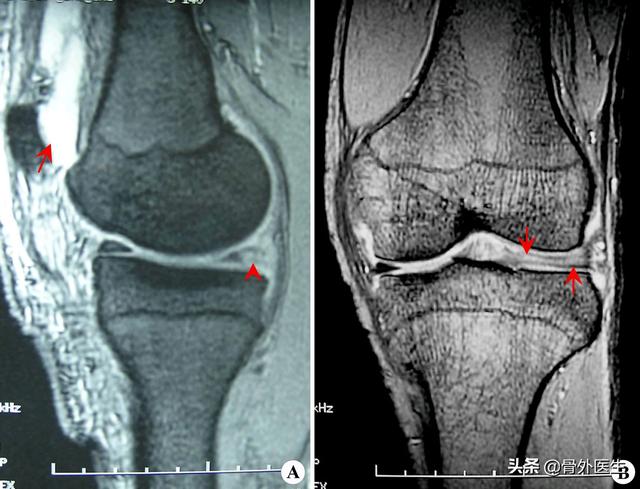 右膝关节内侧半月板后角及外侧半月板前后角变