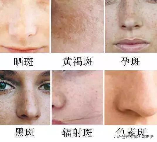 色斑分为很多种苗草丽肤,比如晒斑,雀斑,黄褐斑等等.