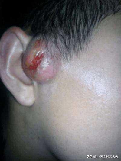 生第一个孩子有耳前瘘管是什么原因引起的如果生第二个孩子还会有吗