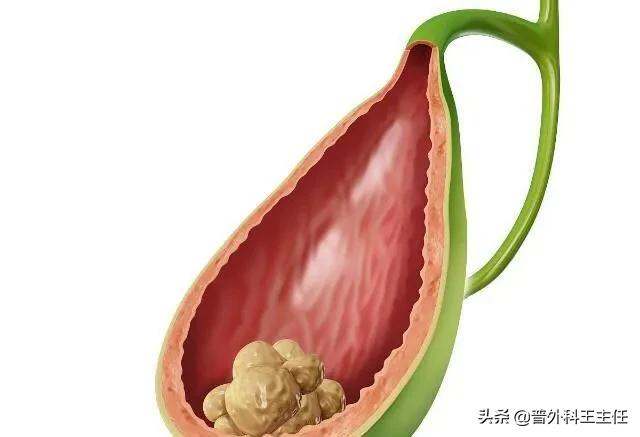 胆囊炎的症状有哪些:胆囊炎为什么晚上疼早上就没事了？