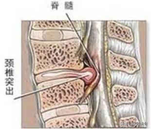 颈神经根炎的症状与治疗:颈椎椎间盘突出C3C4C5压迫神经根及硬膜囊是什么症状？