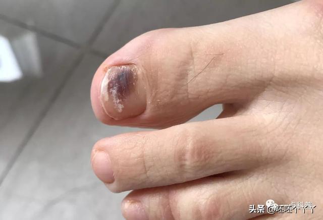 头皮黑色素瘤早期症状图片:头皮黑色素瘤早期症状图片大全 黑色素瘤一般潜伏期多久？有何症状？
